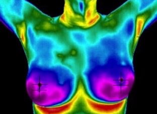 ThermographyImg